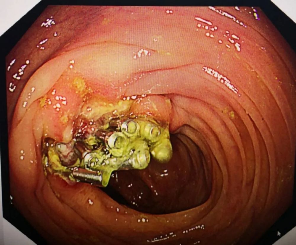 病例结肠多发性息肉分次切除内镜下分片黏膜切除术切除巨大息肉一枚