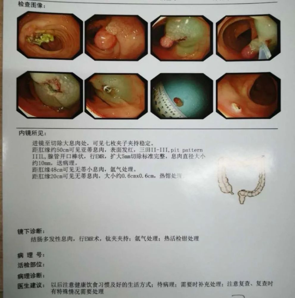 病例结肠多发性息肉分次切除内镜下分片黏膜切除术切除巨大息肉一枚