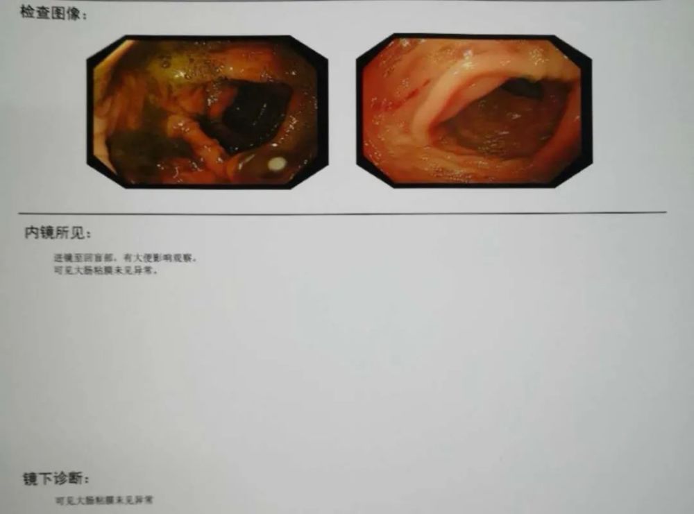 病例结肠多发性息肉分次切除内镜下分片黏膜切除术切除巨大息肉一枚