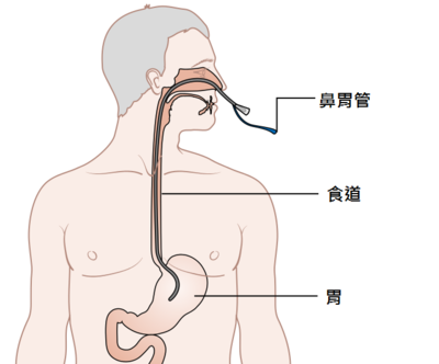 患者家属不愿意的,归其原因是因为下胃管的"恐惧感"殊不知这一决定,给