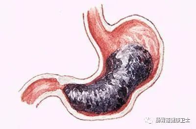 十二指肠溃疡 西医药的治疗原则和治疗方法 腾讯新闻