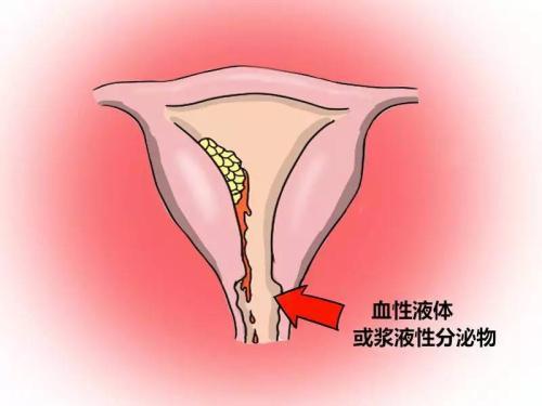 貝安:功能性子宮出血可以試管嬰兒嗎?