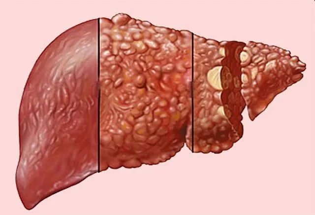 從酒精性脂肪肝到肝癌,需要幾步?