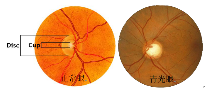 青光眼视野轻度缺损图图片