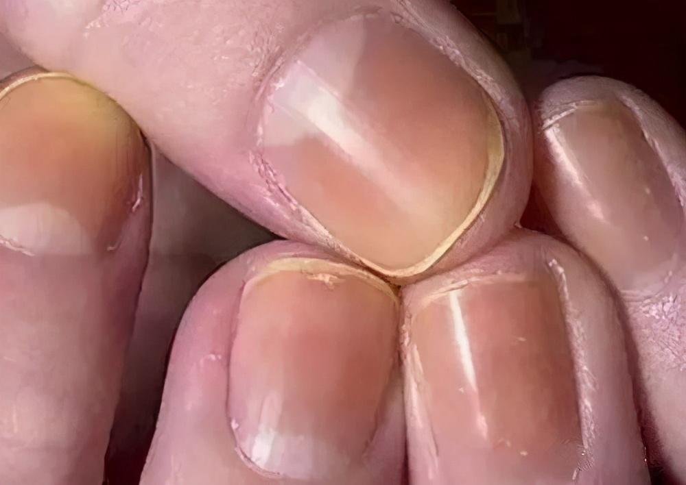 肾脏不好的人,手上会有3种表现,若一个没有,恭喜肾脏还很强