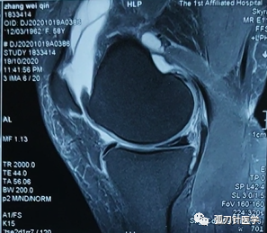 膝關節磁共振檢查顯示:內側半月板后角的三度撕裂傷,關節積液,囊腫