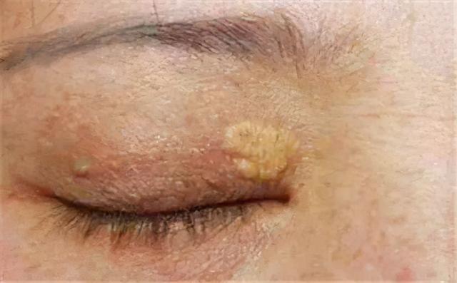 眼睛边出现这种小肉粒,多半是血脂高了,饭后坚持一件事稳定血脂