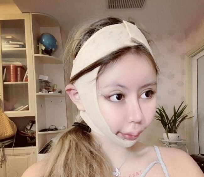 百万粉丝大网红小z娜娜出现整容后遗症!