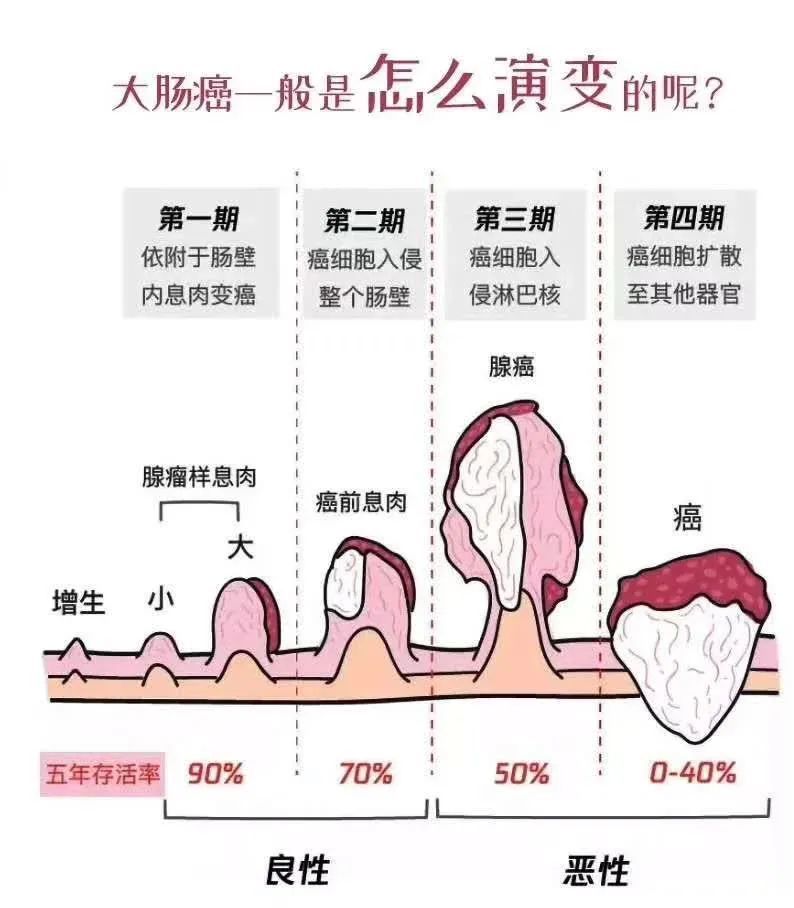 这个"杀手"不太冷——大肠癌,是最容易预防的癌症!
