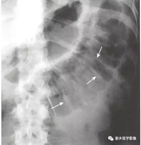 如何看腹部平片