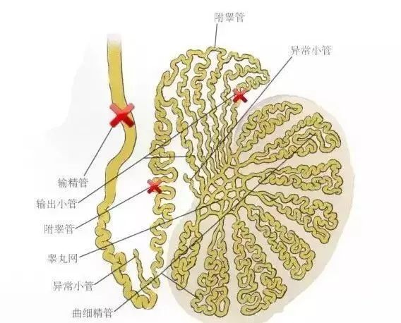 【案例展示】梗阻性无精症|手术比试管更划的着