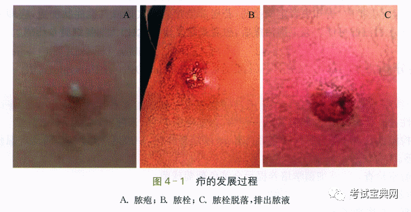 外科学经典病例疖