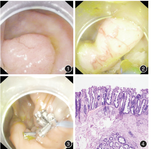 【病例】经内镜逆行阑尾切除术治疗阑尾锯齿状腺瘤一例(附视频