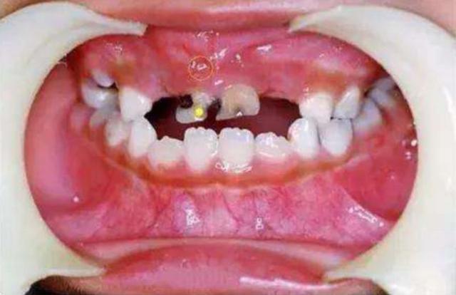 几个儿童换牙小知识,孩子的牙齿健不健康,就看家长懂不懂!