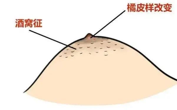女性身体出现7种情况,可能是乳腺癌早期