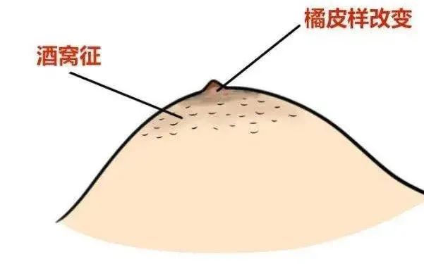 女性乳房凹陷图片