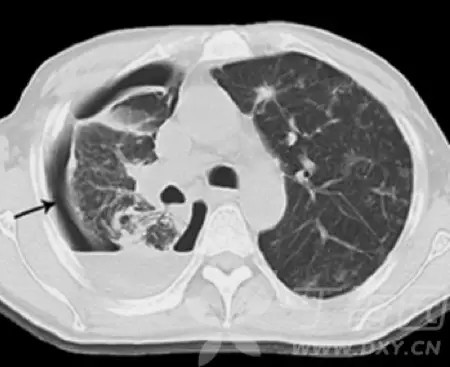 熟記這些 ct 表現,一眼識破轉移性肺癌