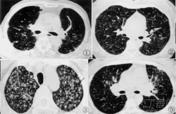 熟记这些 ct 表现,一眼识破转移性肺癌_腾讯新闻