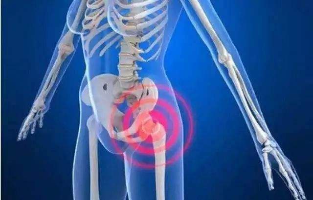 髋关节疼痛是股骨头坏死了吗髋关节疼痛到底是怎么回事