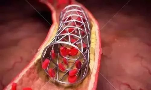 心脏病|刚下的心脏病支架又堵了！究竟是怎么回事？医生指出3个原因