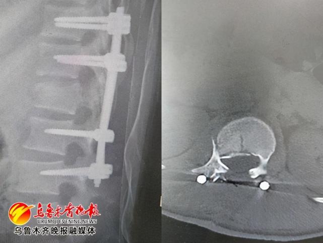 四米高处摔下意外瘫痪 一年后重新站立再返岗 腾讯网