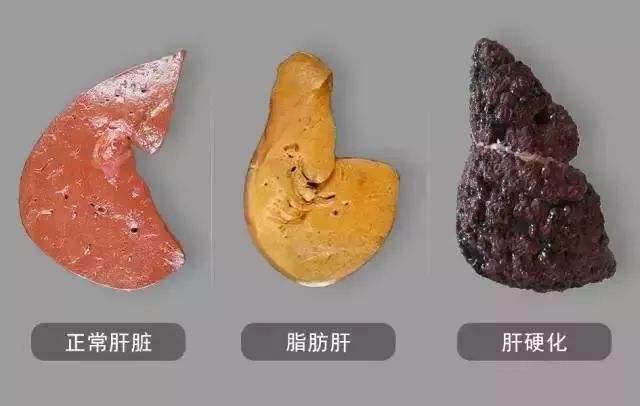 睡前爱玩手机的人出现5种异常暗示你肝即将报废