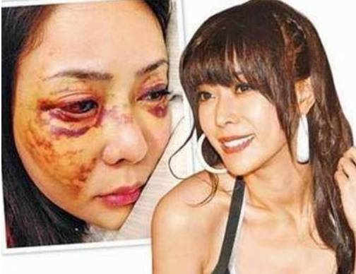 被家暴的八位明星,她结婚13天被丈夫砍掉手指,怀孕15周被踢流产