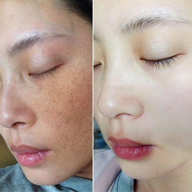 润泉贝儿教你高效的祛斑方法|斑点|色斑|黑色素|润泉贝儿|祛斑|祛斑