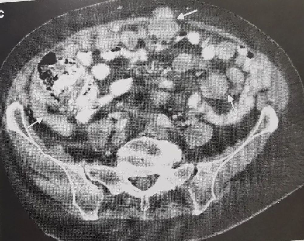 影像检查在卵巢癌分期中的作用