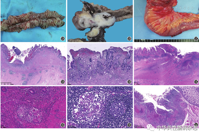 中國炎症性腸病病理診斷專家指導意見_騰訊新聞