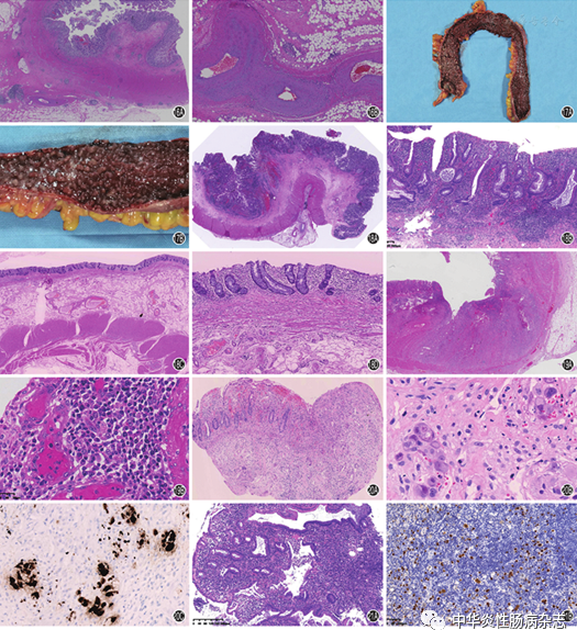 25物镜):肠壁溃疡,纤维组织增生,肠壁炎症细胞浸润;16b(he × 2物镜)