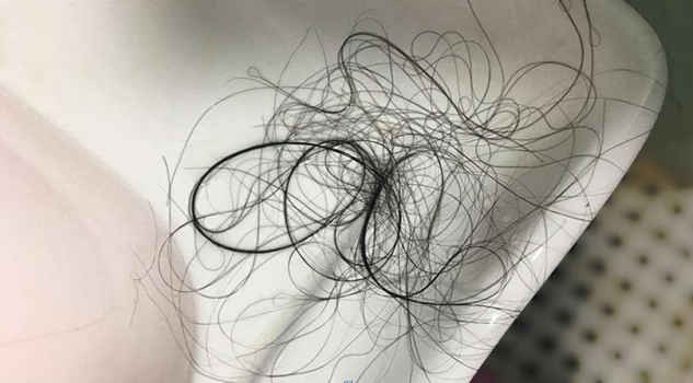 脱发吃什么,脱发吃什么药效果好