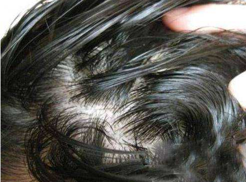 脱发吃什么,脱发吃什么药效果好