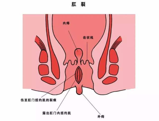 肛裂,就是我们肛门的位置多了一道裂口,常发于肛门后,前正中,以肛门后