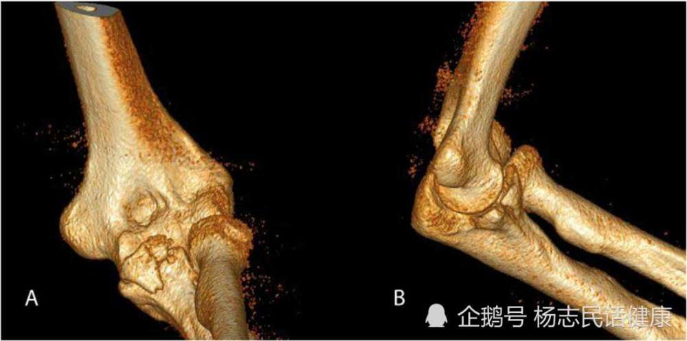 肘关节什么时候变形的 为什么自己还不知道 腾讯新闻