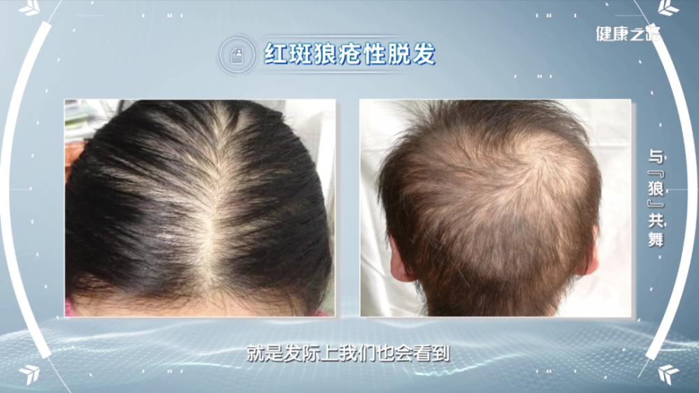 预告|走近"不死癌症"红斑狼疮 "人民"专家教您如何与"狼"共舞