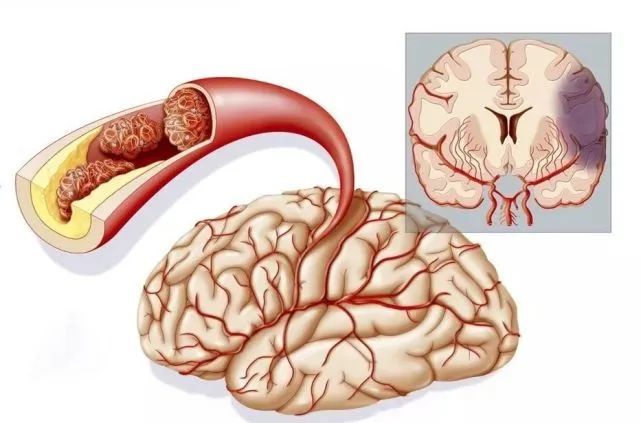 脑梗塞|冬春交替，防脑梗，出现4个“信号”，去查查脑CT，莫拖延