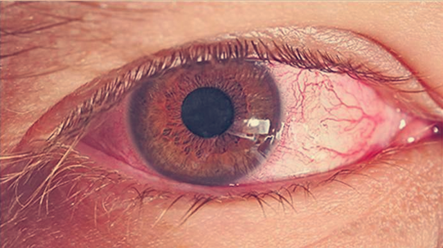 眼睛血管瘤的症状图片图片