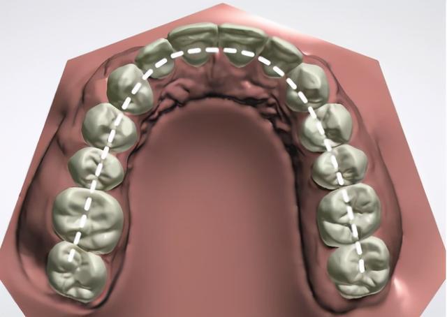 科普丨什么是牙弓如何看宽窄