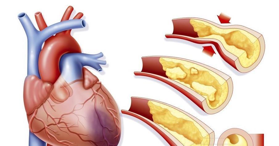 动脉粥样硬化吃药能彻底逆转吗辟谣做好这两点更重要