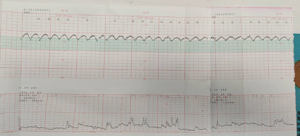 不明原因的产科死亡波正弦波