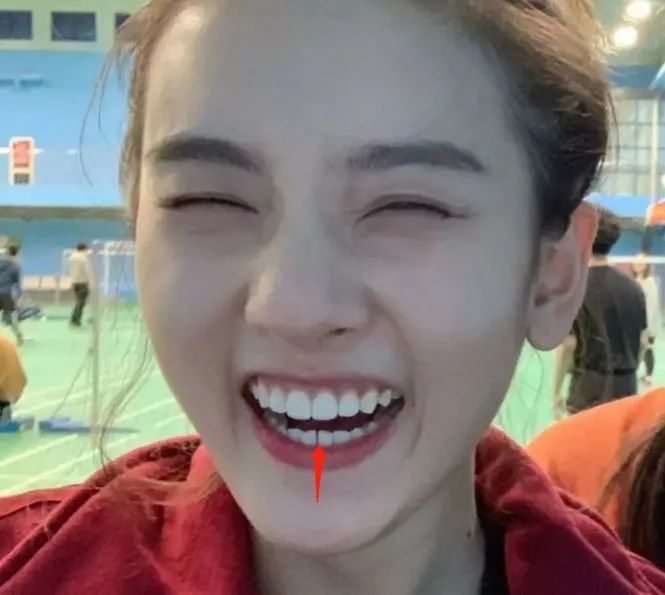 下面两颗门牙稍微有一丢丢向里旋转,导致了一个不大不小的牙缝(缺口)