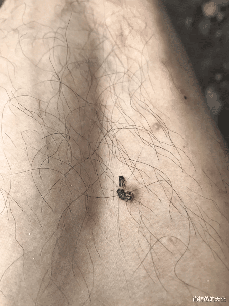 被狗咬过的牙印20多年了今天出血了怎么办哈哈哈评论太皮了