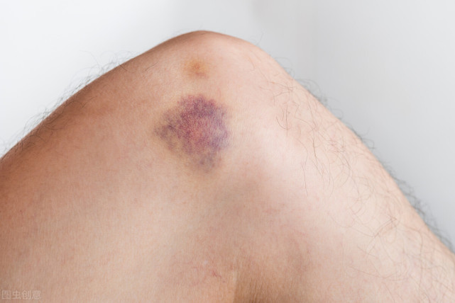 膝盖总是不明原因的青一块紫一块 背后或隐藏着 这3种血液病 过敏性血管炎 血液病 膝盖 血管 毛细血管破裂 过敏性紫癜
