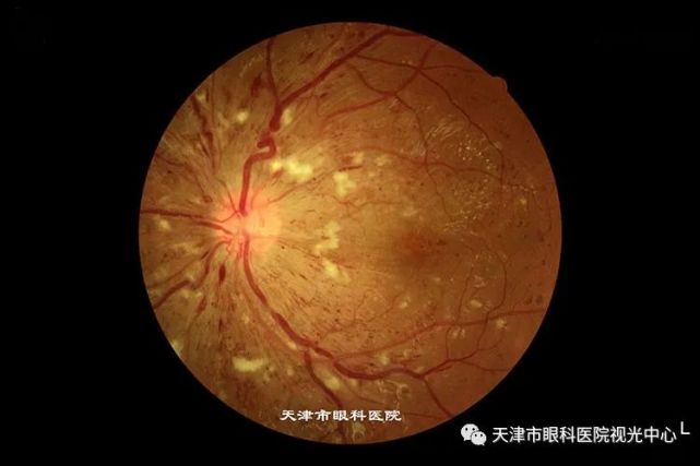 眼睛里长了 小翅膀 是怎么回事 知乎