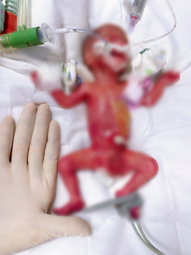 出生仅400克!全国第二轻的"巴掌宝宝",用170天创造了生命奇迹