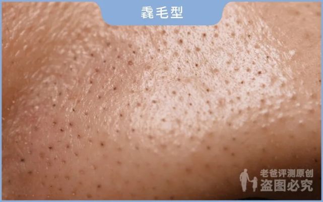 前方高能！实拍挤黑头全过程，不同种类高清放大对比，看看你是哪种黑头！_腾讯新闻