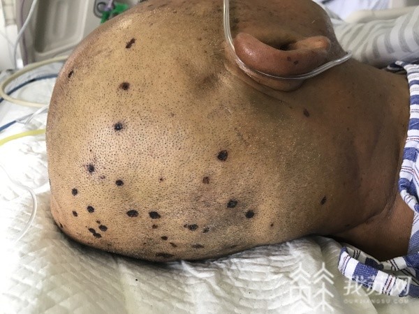 日前,江苏省中医院急诊科收治了一位被马蜂蜇咬的病人,50多岁的张女士