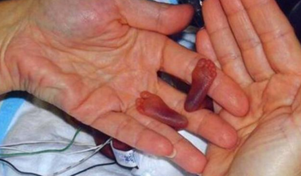 那个出生只有25厘米,破纪录的国外女婴,14年过去,竟长成这样