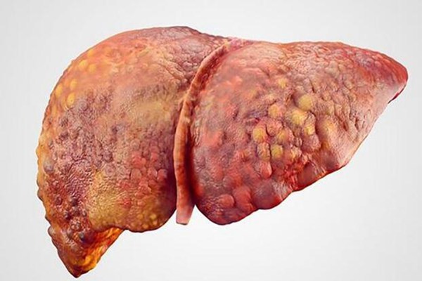 肝硬化早期症状有哪些 患上肝硬化可以治愈吗
